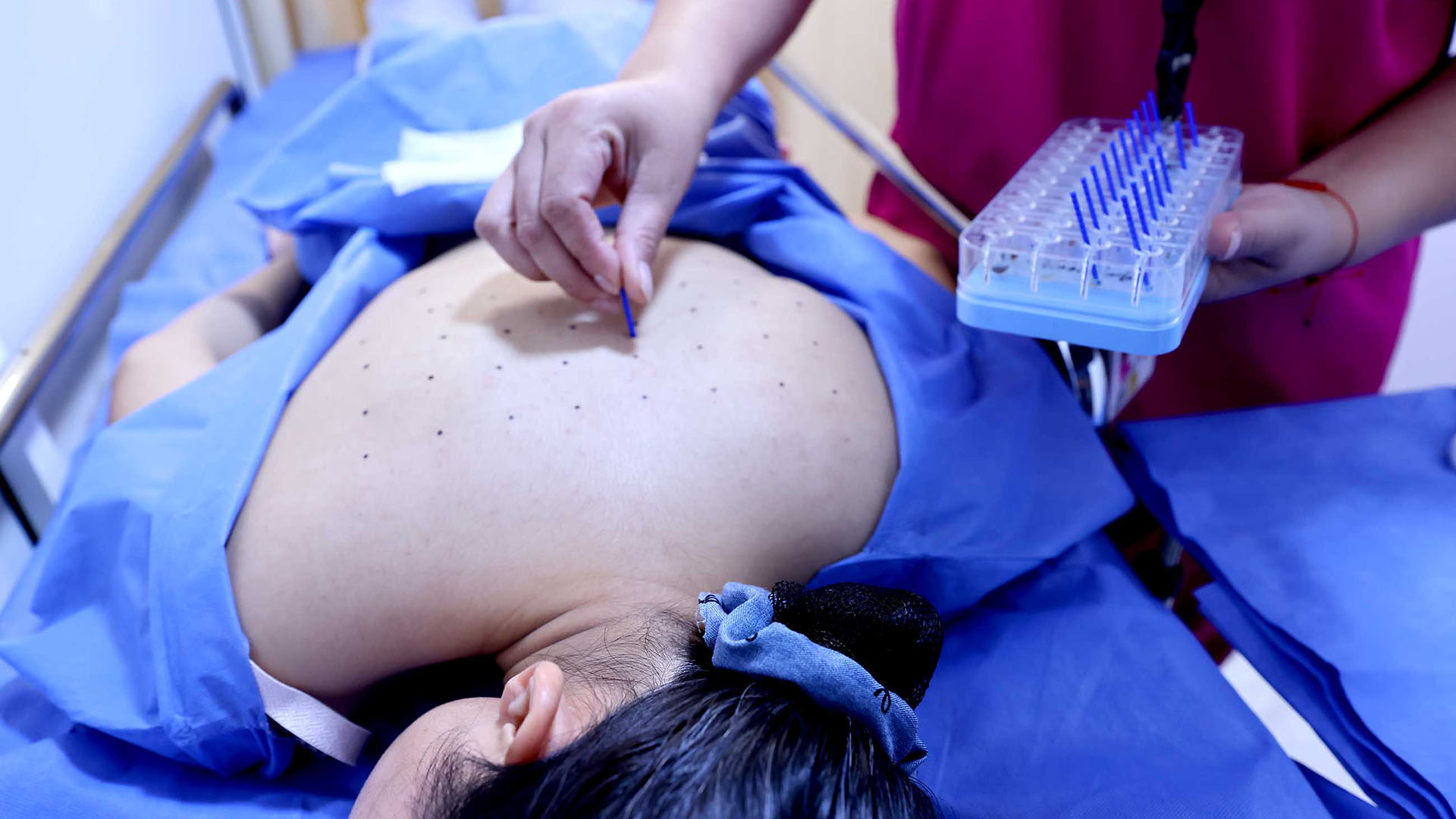 Alergias, un problema de salud que crece en todo el mundo